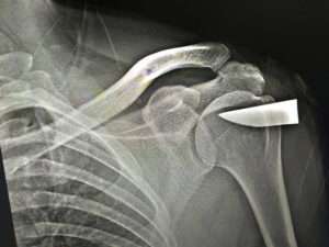 Read more about the article Medics Find Six-Centimetre Knife Blade Wedged In Man’s Shoulder