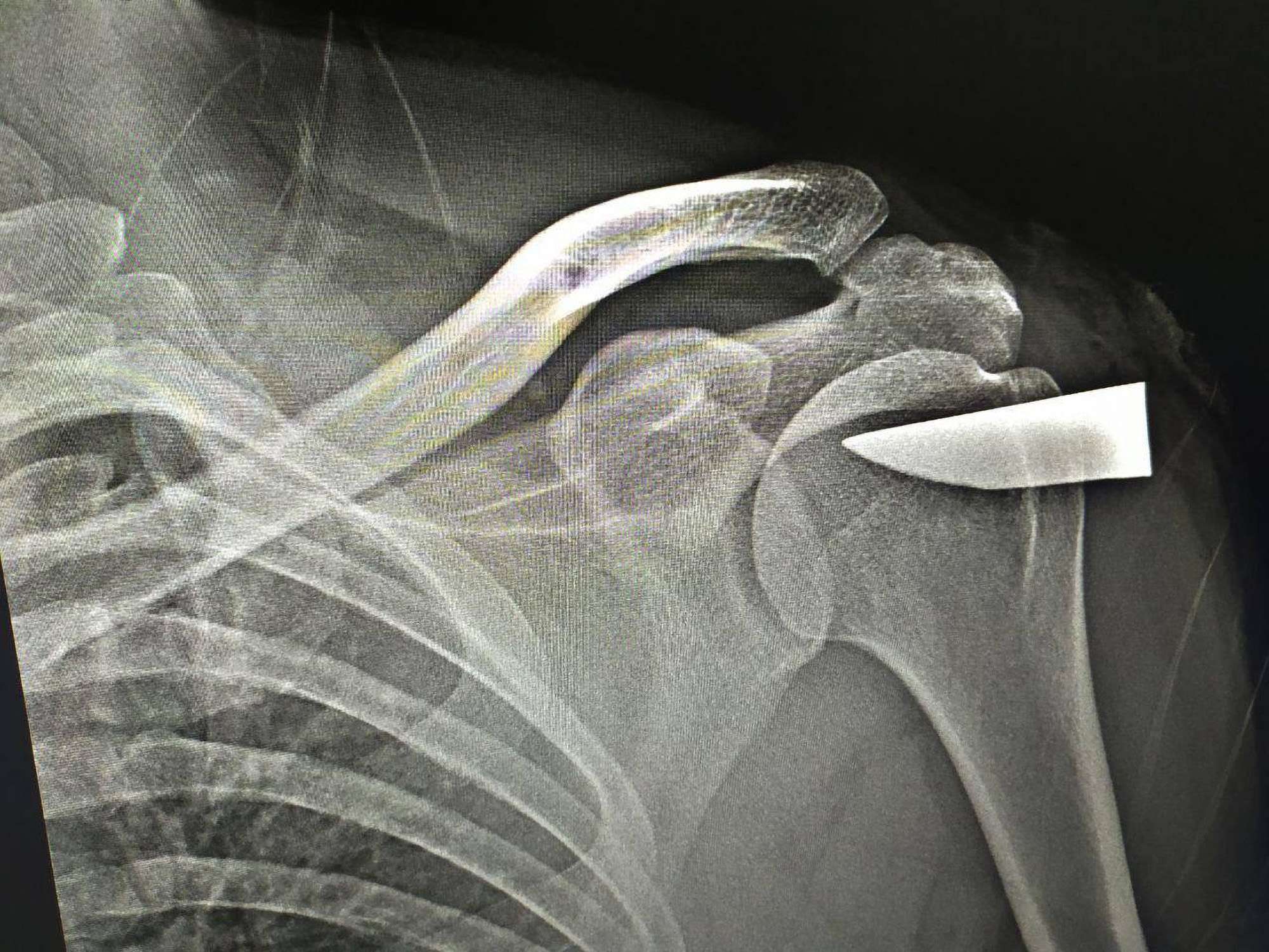 Read more about the article Medics Find Six-Centimetre Knife Blade Wedged In Man’s Shoulder