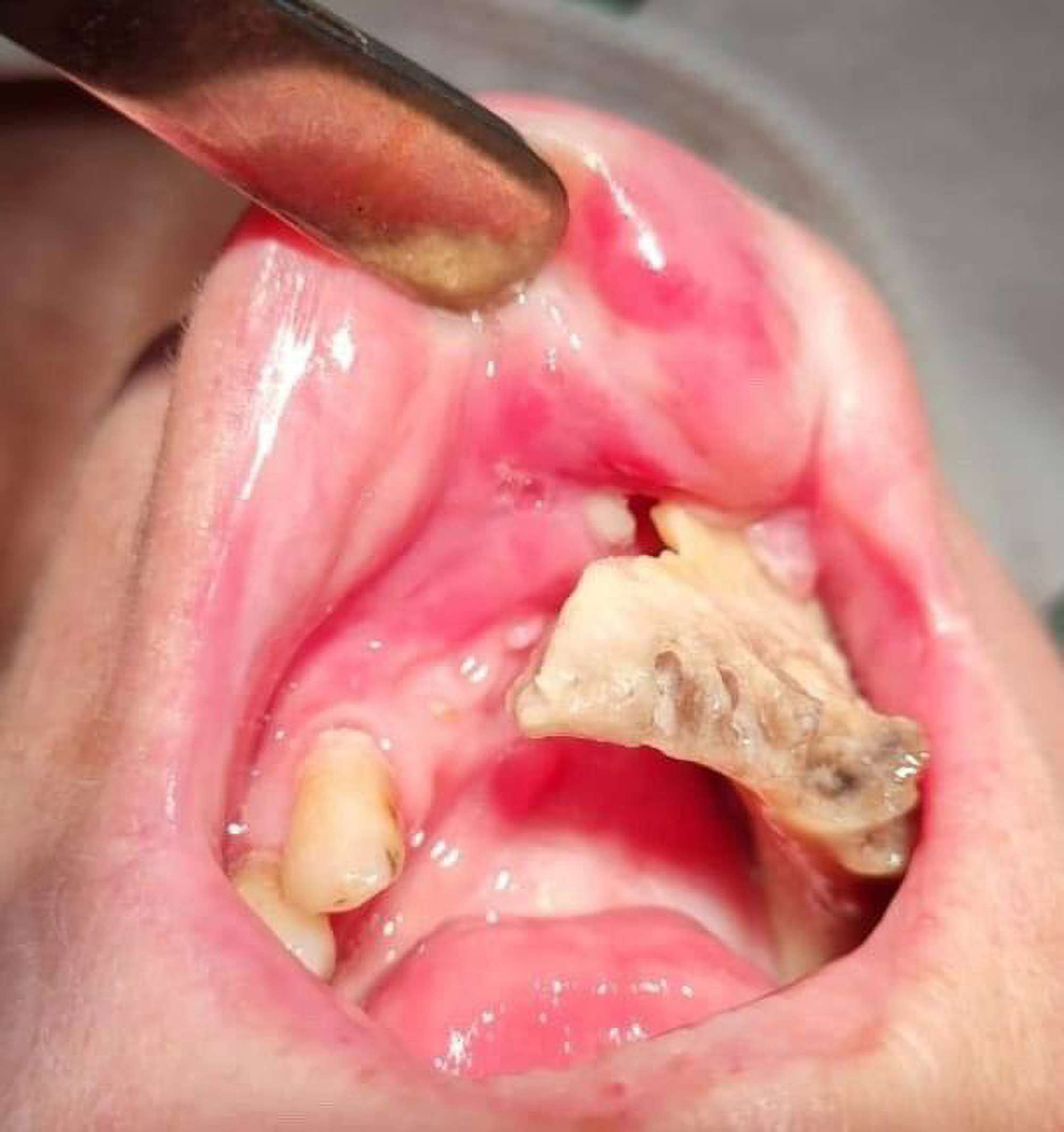 Read more about the article Woman So Scared Of Dentists She Let Her Jaw Rot