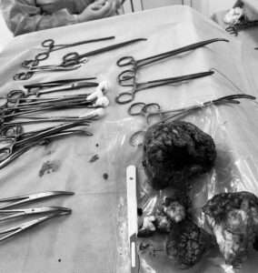 Read more about the article Baffled Surgeons Remove Polyurethane Chunks From Teen’s Stomach