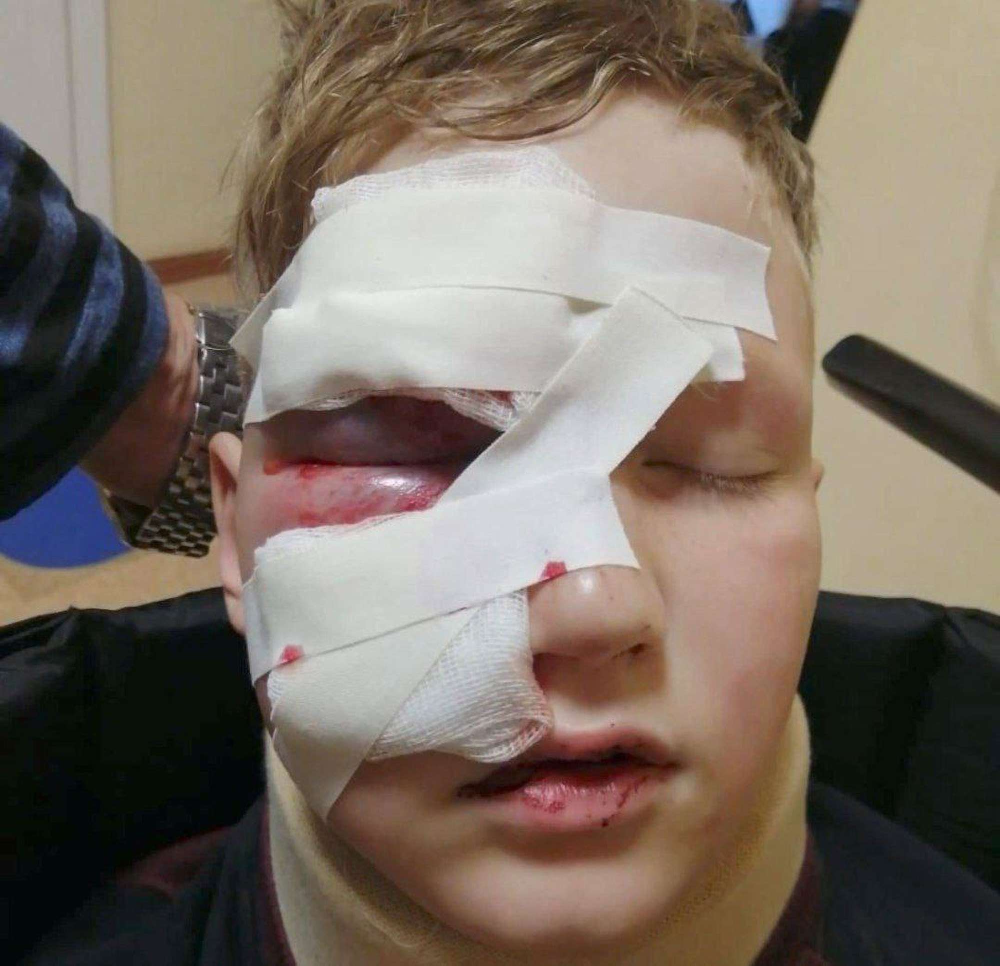 Read more about the article Schoolboy’s Skull Smashed By Exploding Keg