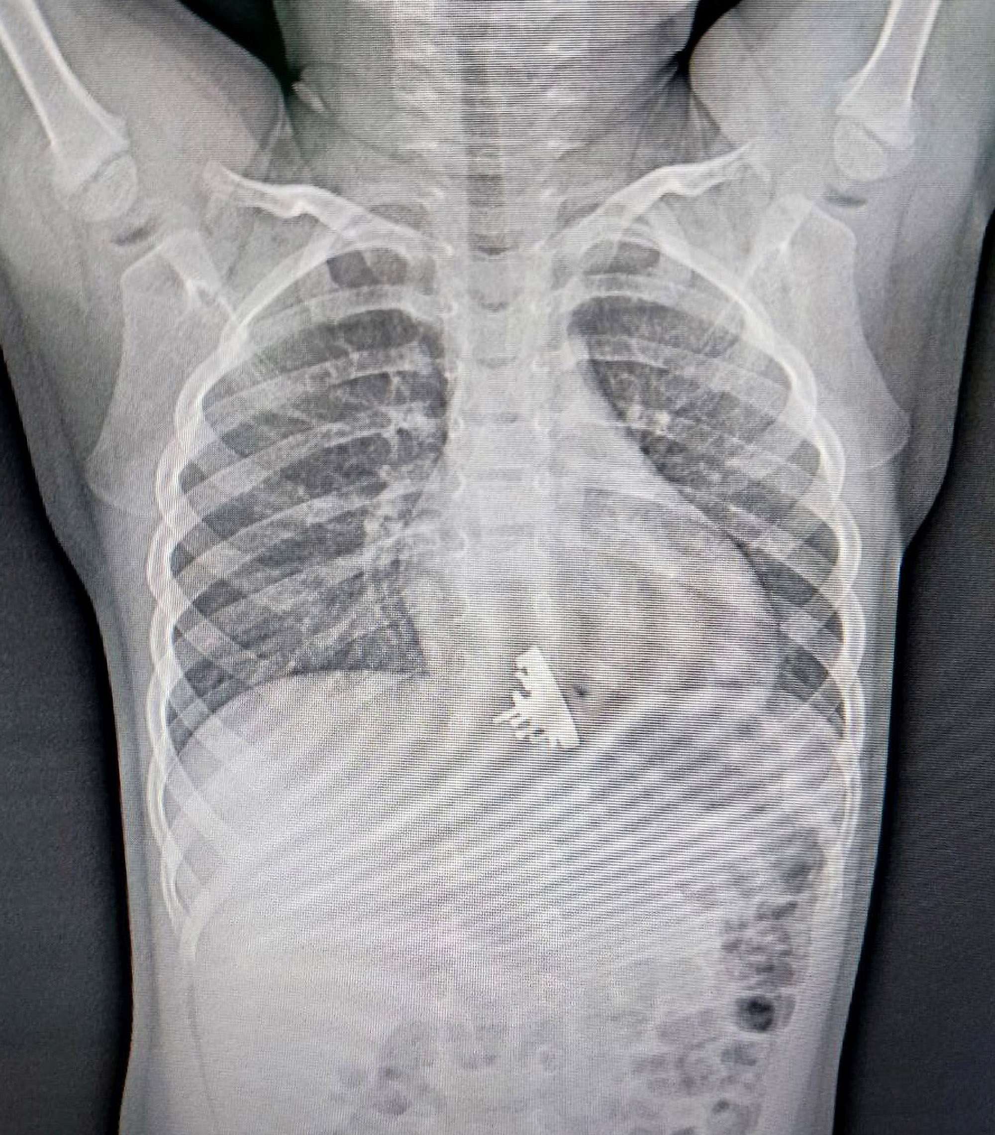 Read more about the article Astonished Docs See Russian Battleship In Girl’s Throat On X-Ray Picture